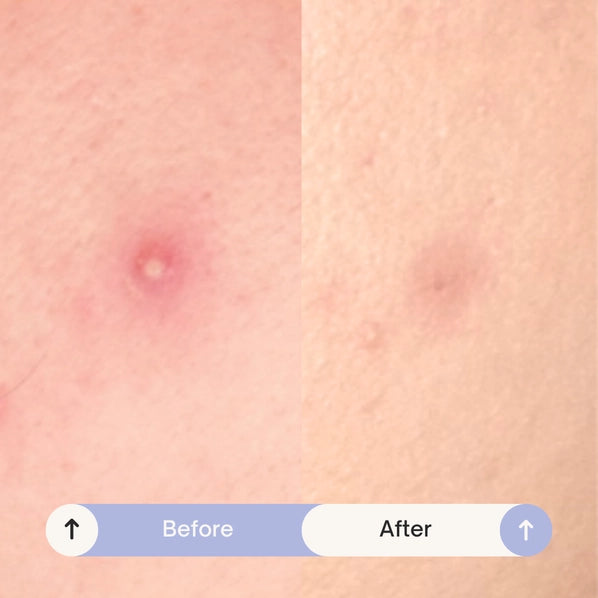 Spotted Nighttime - Original Hydrocolloid Patches | Maskeraide